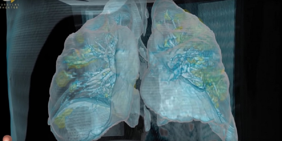 Κορωνοϊός: Βίντεο δείχνει καρέ καρέ πώς ο κορωνοϊός προκαλεί ζημιά στους πνεύμονες