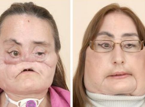 ΗΠΑ : Απεβίωσε η πρώτη Αμερικανίδα που υποβλήθηκε σε μεταμόσχευση προσώπου