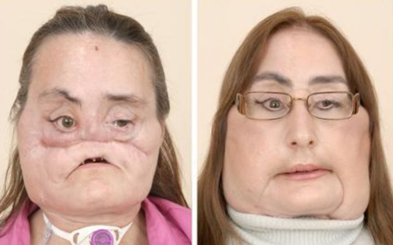 ΗΠΑ : Απεβίωσε η πρώτη Αμερικανίδα που υποβλήθηκε σε μεταμόσχευση προσώπου