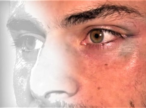Η αξονική, το σπασμένο ζυγωματικό του Μασούρα, η διπλωπία, η κλοτσιά του Γκαραβέλη και ο… Φουστέρ