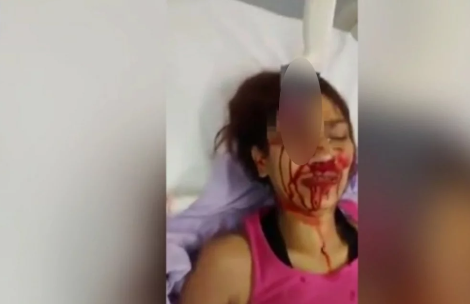 Βίντεο σοκ – Γυναίκα με μαχαίρι καρφωμένο στο φρύδι μετά από «επίθεση από τον μεθυσμένο σύζυγό της»