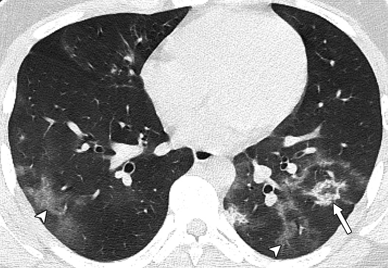 Συγκλονίζει η ανάρτηση Μαγιορκίνη – Δείτε τις βλάβες στους πνεύμονες ανήλικων που νόσησαν με κορωνοϊό