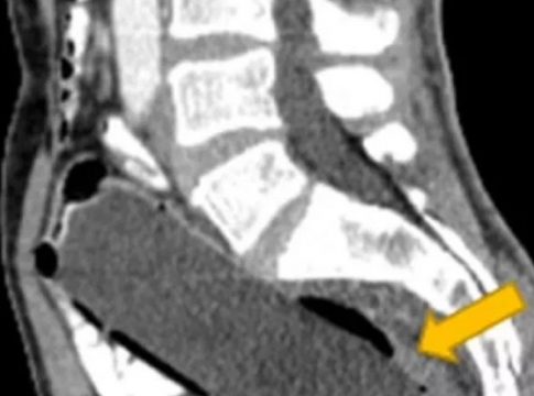 Έβγαλαν μπουκάλι 19 εκατοστών από τον πισινό άνδρα – Γιατί δεν είχε πει τίποτα στη γυναίκα του