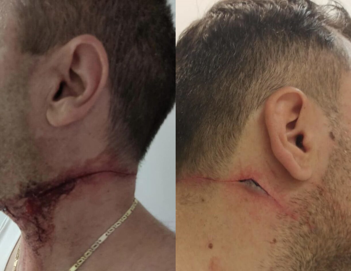 Σοκάρουν οι φωτογραφίες από τους τραυματίες αστυνομικούς που μαχαιρώθηκαν στο λαιμό