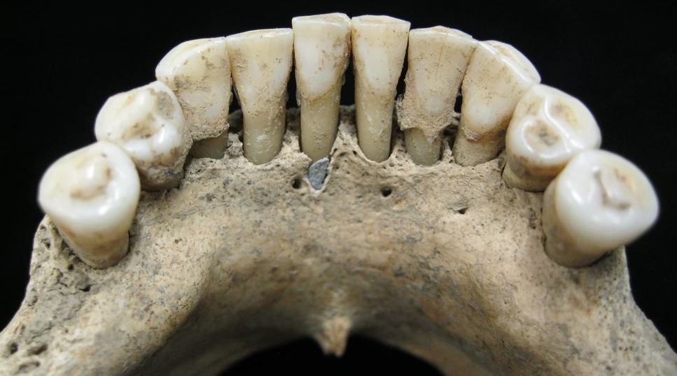 Μυστήριο: Γιατί μια μοναχή του Μεσαίωνα είχε κρυμμένο λάπις λάζουλι στα δόντια της;