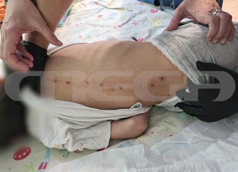 Θρίλερ με το παιδί και τα σημάδια στην πλάτη – Παρέμβαση εισαγγελέα μετά τις αποκαλύψεις