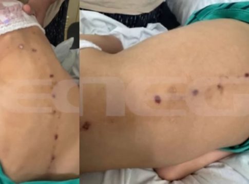 Νέα στοιχεία για την υπόθεση του 10χρονου παιδιού με τα σημάδια σε όλο του το κορμί