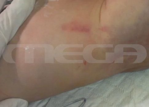 Αποκαλύψεις για το 2,5 ετών βρέφος που πέθανε από κακοποίηση – Τι υποστήριζε τότε ο ιατροδικαστής
