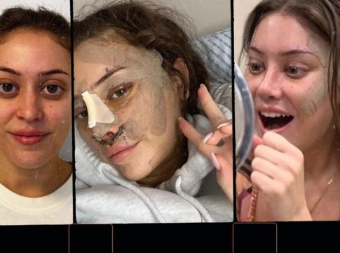 Λίφτινγκ στα 28: Γιατί η γενιά του Instagram στρέφεται στο νυστέρι; Η άνοδος, η προειδοποίηση, η ανησυχία