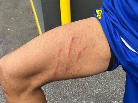 Άρης: Η σκαριά στον μηρό του Ρόουζ από το άτσαλο μαρκάρισμα του Ιβανούσετς (pic)