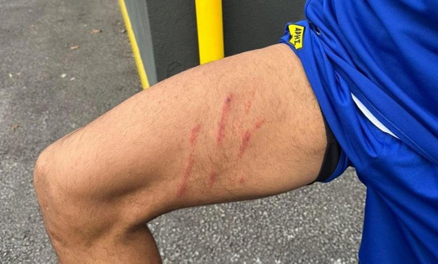 Άρης: Η σκαριά στον μηρό του Ρόουζ από το άτσαλο μαρκάρισμα του Ιβανούσετς (pic)